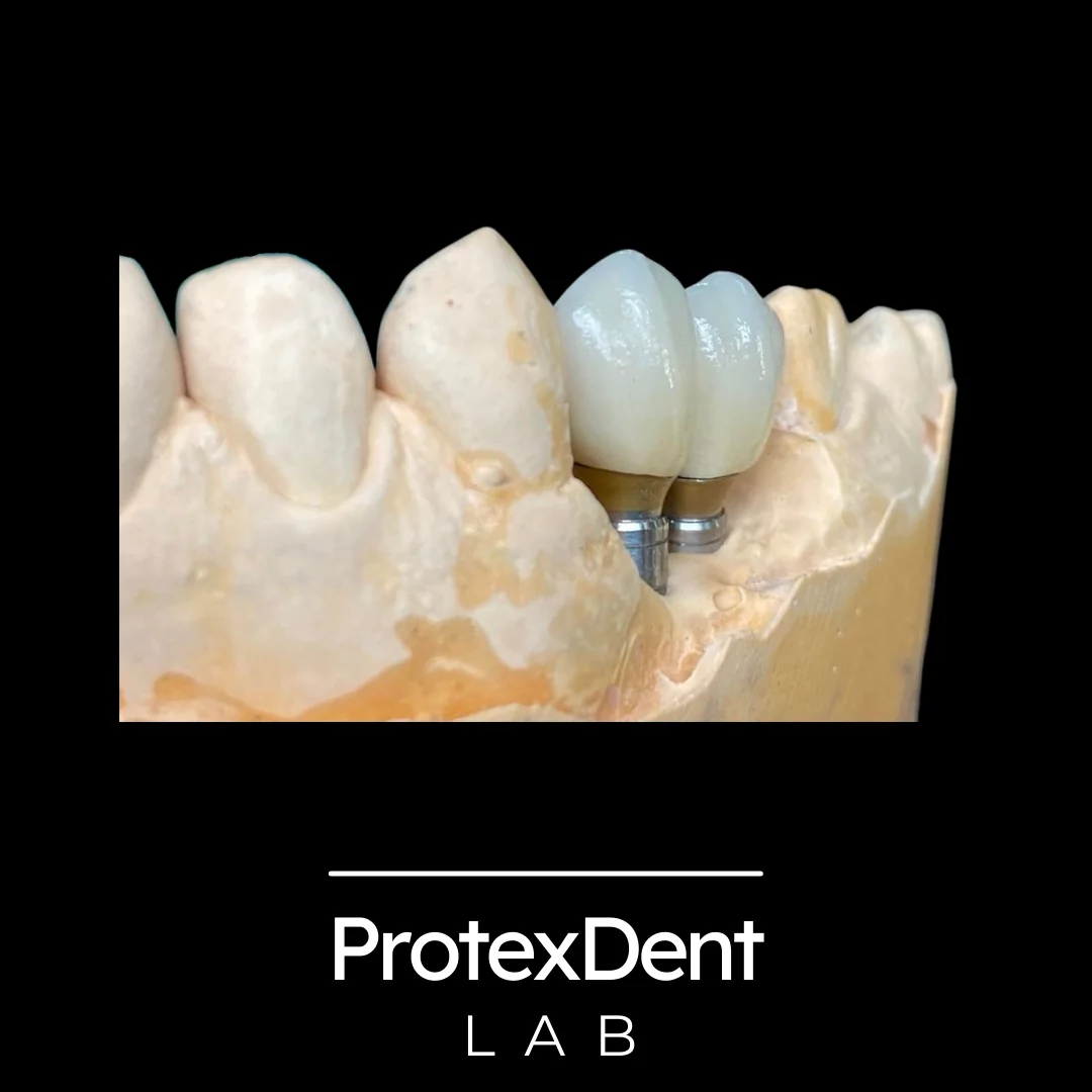 Implant dentystyczny – protetyka Gorlice
